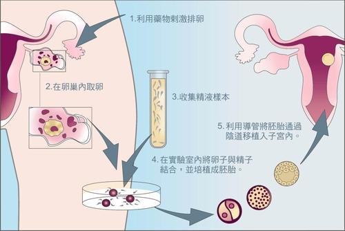 生育-如何在重庆实现试管婴儿？什么是第三代试管婴儿测试？